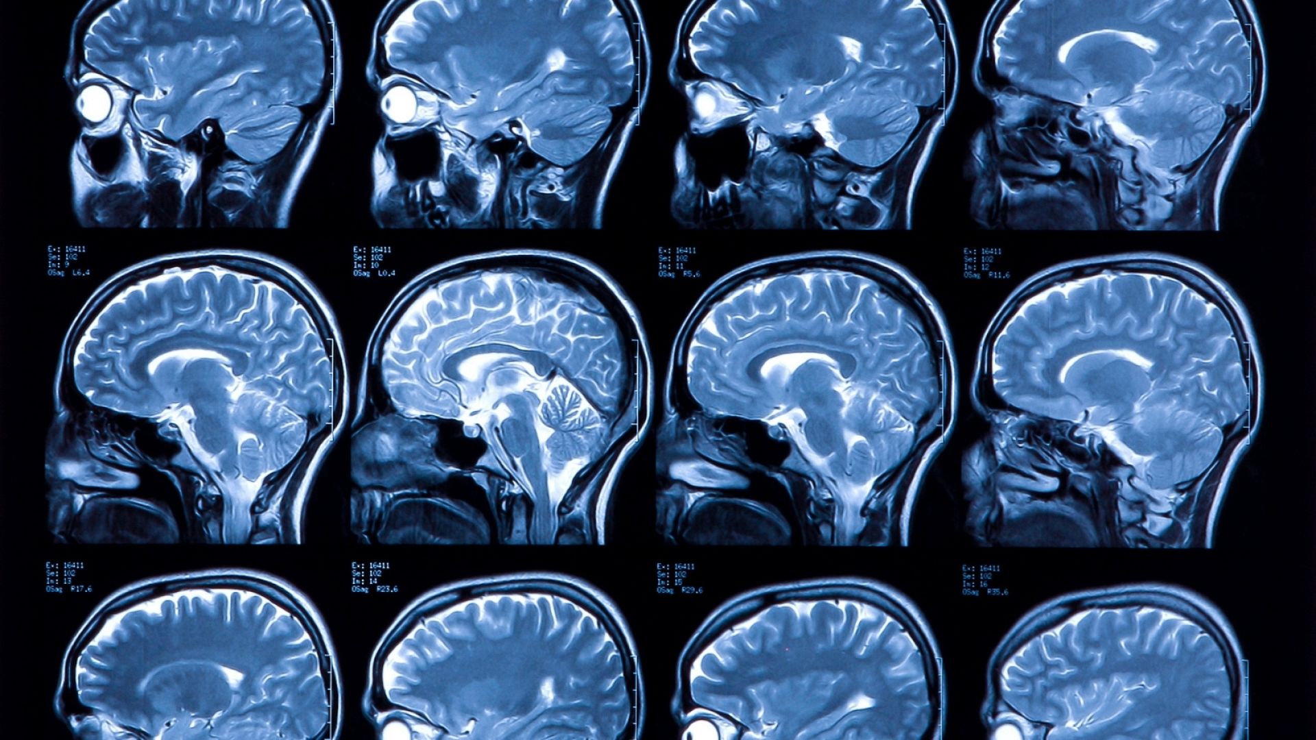 Brain Tumor Classification